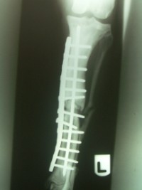 X-Ray After Treatment